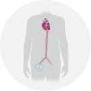 Transcatheter Aortic Valve Implantation 1