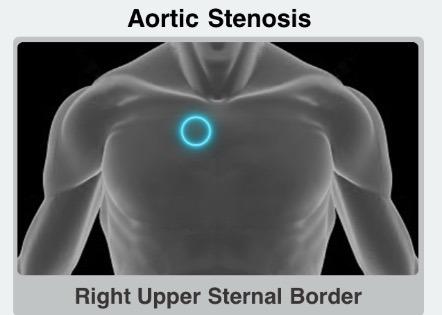 Diagnosis of Aortic Stenosis 1