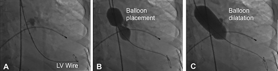 Balloon Valvuloplasty Procedure
