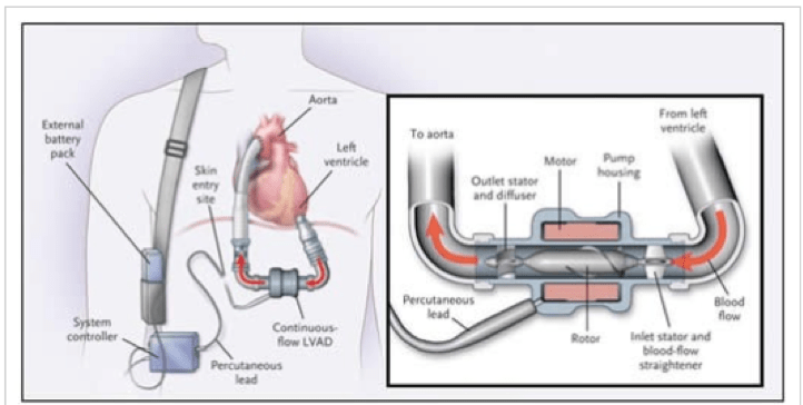 Implantable Cardiac Device 6