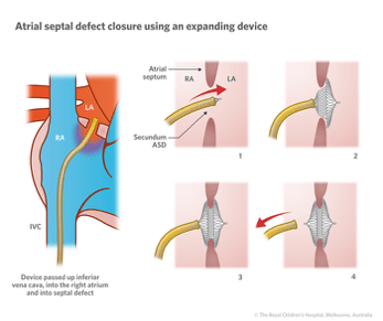 Atrial Septal Defects 2