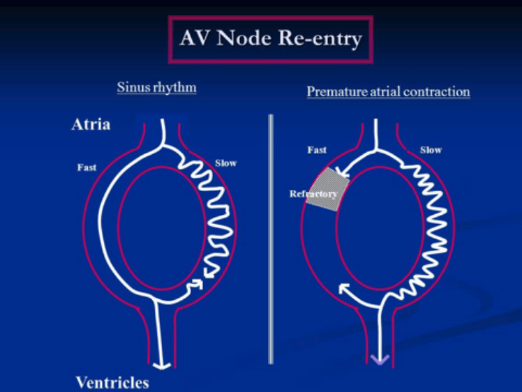 Atrioventricular nodal re-entry