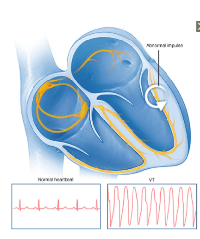 Ventricular Tachycardia 1