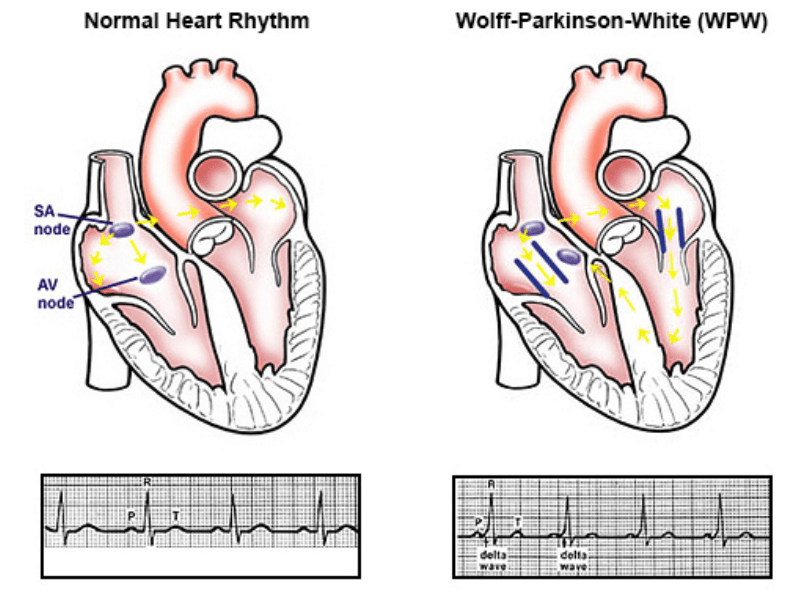 wolf parkinson syndrome ablation