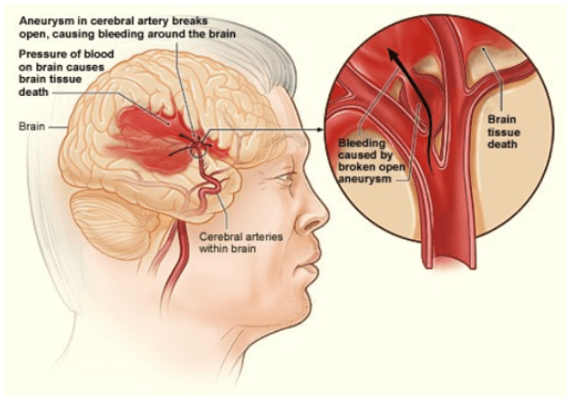 Cardiovascular Disease in Stroke 2