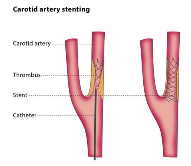 Treatment of Carotid Artery Stenosis 1