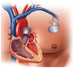 Dual-Chamber Pacemaker