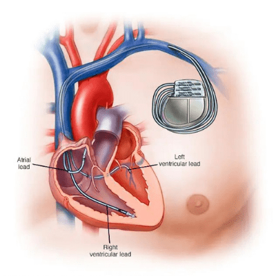 Biventricular pacemakers