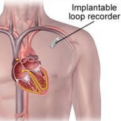 Image of of an implantable loop recorder 