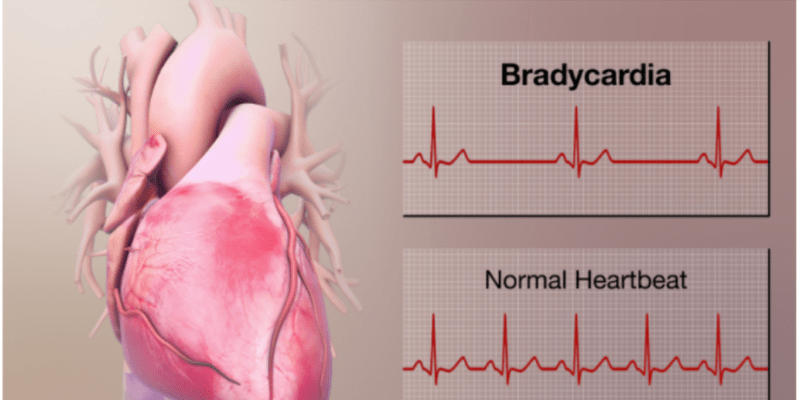 Image explaining Bradycardia