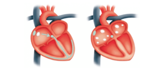 Do Smart Watches Work in Detecting Irregular Heart Rhythms? 1